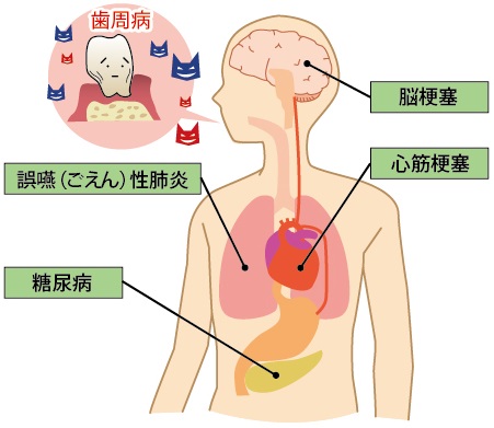 歯周病からくる様々な病気